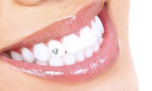 Choice of Dental Treatment