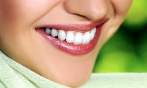 Teeth Whitening with Consultation